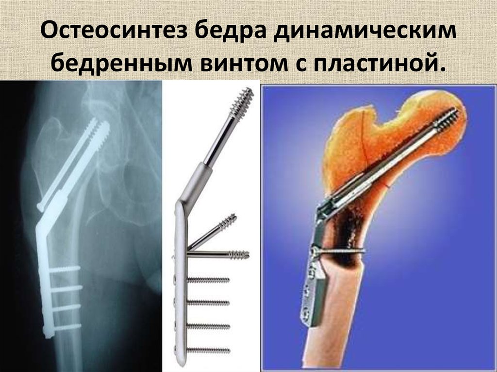 Остеосинтез бедренной. DHS пластина остеосинтез бедра. Экстрамедуллярный остеосинтез. Остеосинтез DHS фиксатором. Экстрамедуллярный остеосинтез бедра.