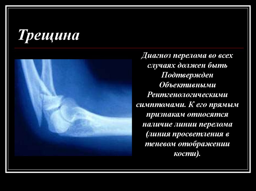Трещина определение. Симптомы при трещине кости. Признаки перелома и трещины.
