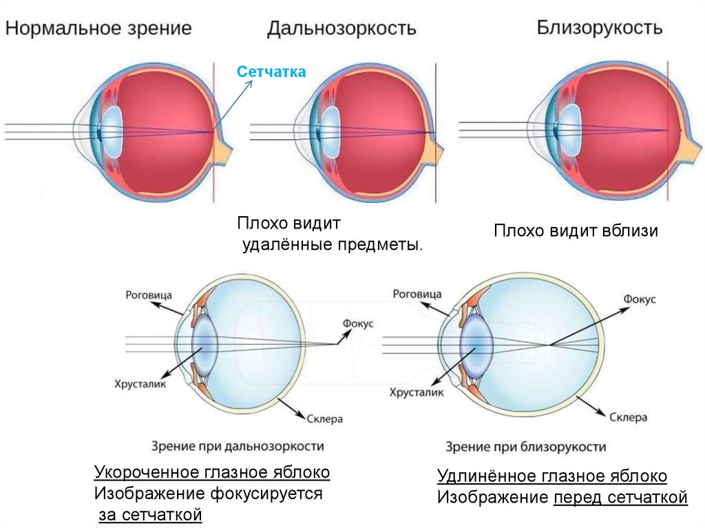Почему видит глаз. Дальнозоркость и близорукость строение глаза. Нормальное зрение близорукость дальнозоркость схема. Форма глазного яблока при миопии. Строение глаза дальнозоркость.