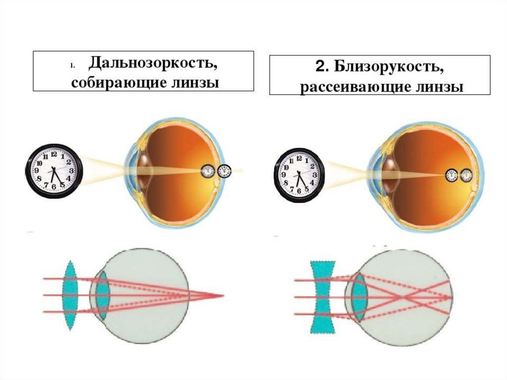 Сложный гиперметропический астигматизм глаз. Линзы для глаз для зрения дальнозоркость. Линзы необходимые при близорукости. Коррекция близорукости и дальнозоркости с помощью линз. Контактные линзы дальнозоркости близорукости.