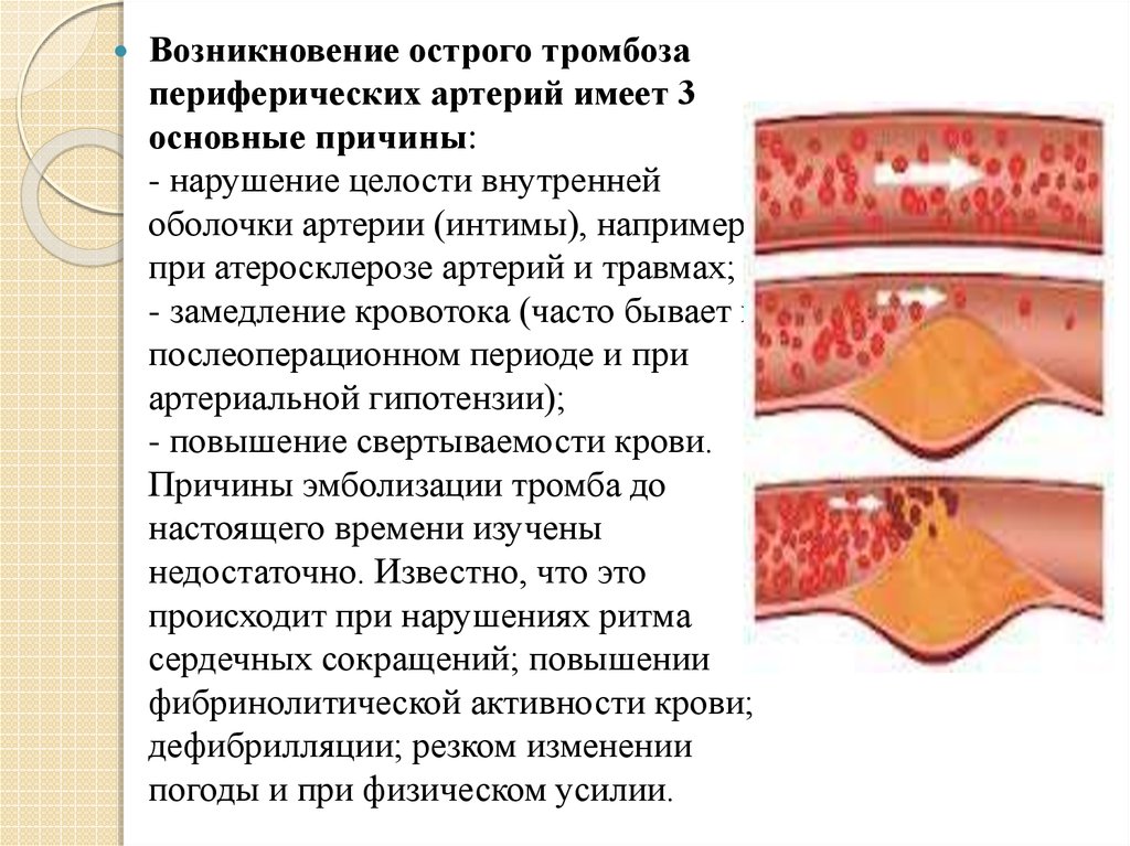 Острая артериальная непроходимость нижних конечностей презентация