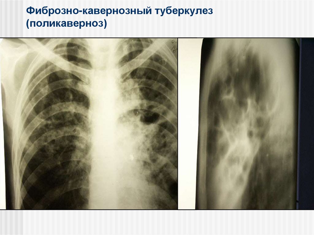 Умеренные фиброзные изменения. Фиброзно-кавернозный туберкулез рентген. Рентген фибиринозно-кавернозый туберкулез. Рентген фибиринозно-кавернозый тубркулез. Кавернозный туберкулез рентген.
