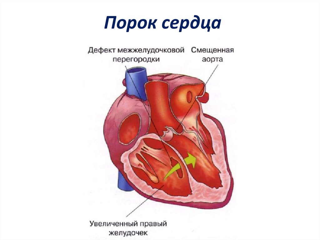 Как выглядит порок сердца на картинке