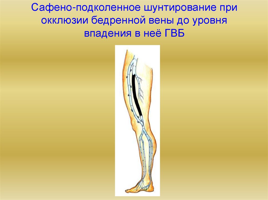 Подколенно бедренного. Сафено-подколенное соустье. Бедренно-подколенное шунтирование. Подколенно-тибиальное шунтирование. Бедренно подколенный шунт тромбоз.