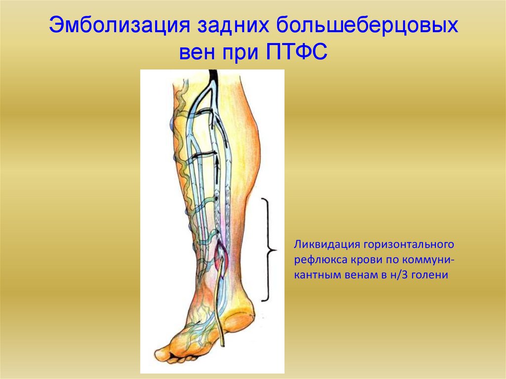 Подвздошная вена где находится фото тромбоз