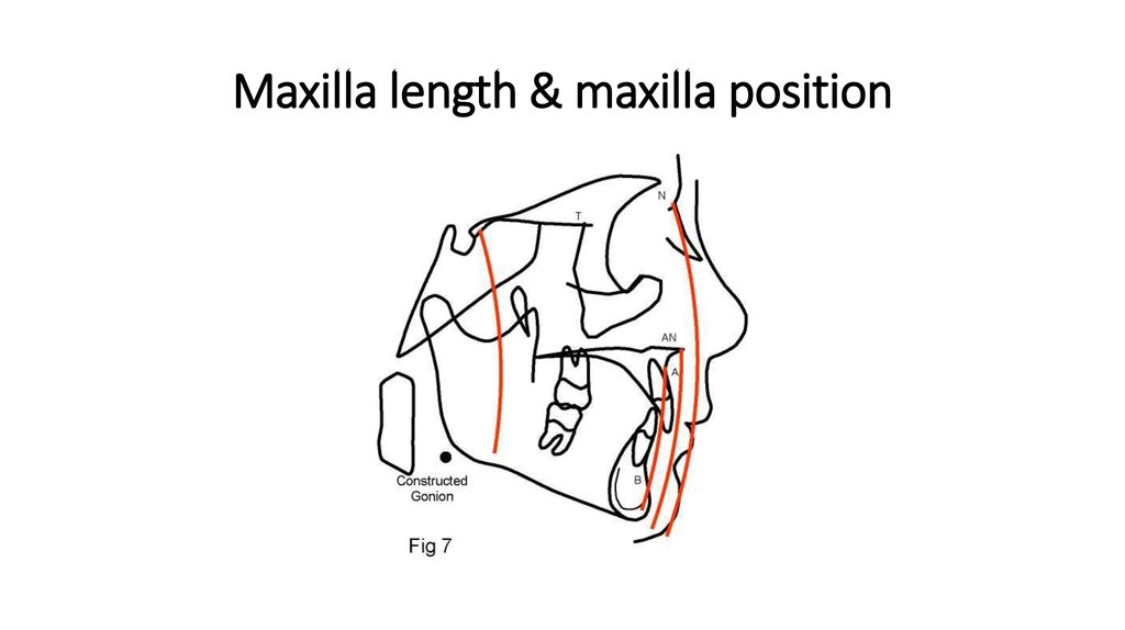 Maxilla length & maxilla position