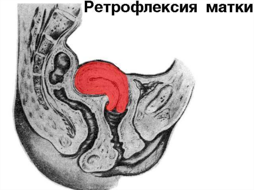 Матка кзади. Загиб матки ретрофлексия. Ретроверсия и ретрофлексия матки.