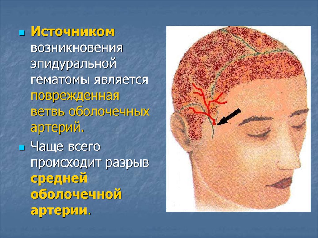 Повреждения головного мозга возникают. Источник эпидуральной гематомы. Кефалогематома и эпидуральная гематома. Ушиб головного мозга презентация. Травмы головного и спинного мозга презентация.