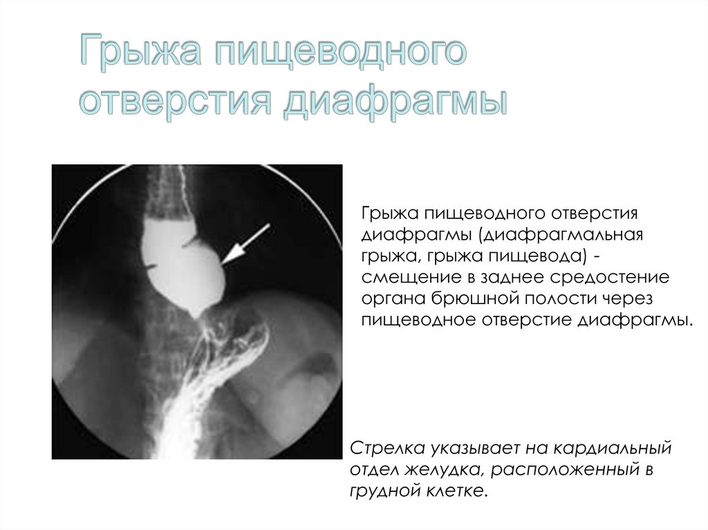 Грыжа пищеводного отверстия симптомы лечение