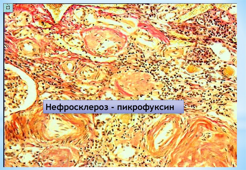 Артериолосклеротический нефросклероз микропрепарат рисунок