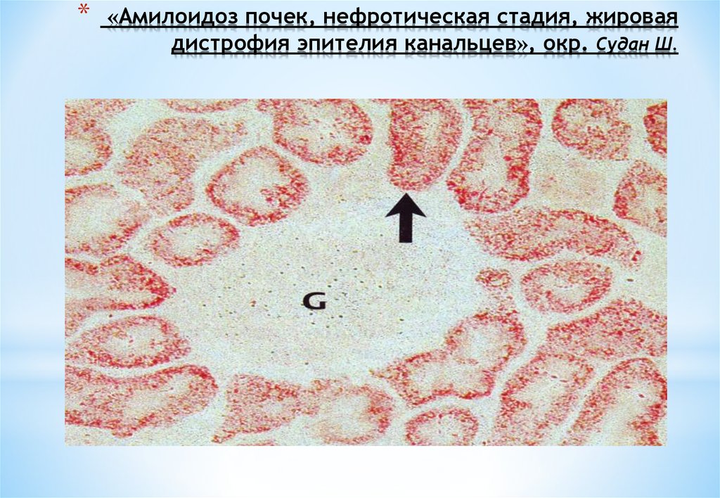 Дистрофия почек фото