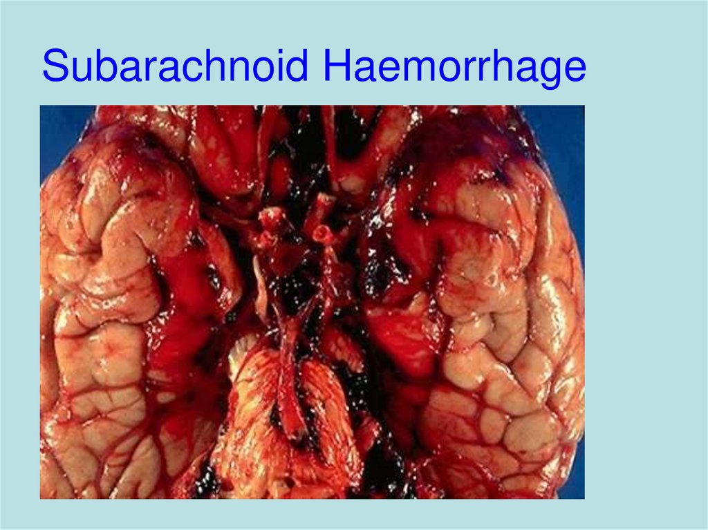 Subarachnoid Haemorrhage