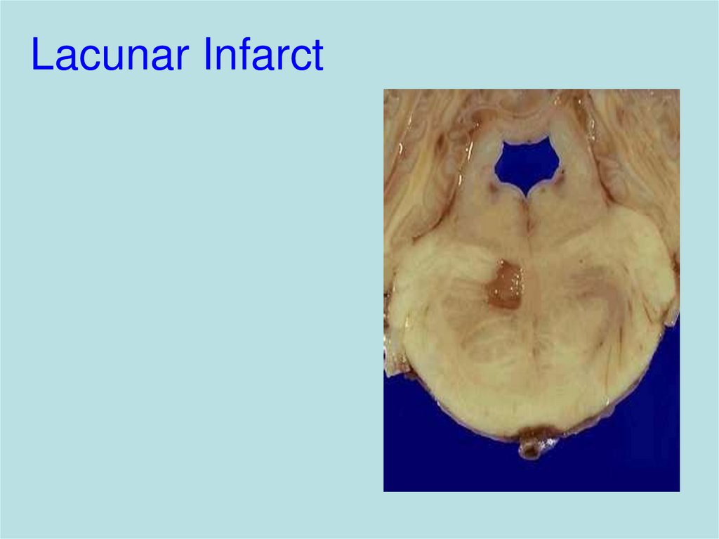 Lacunar Infarct
