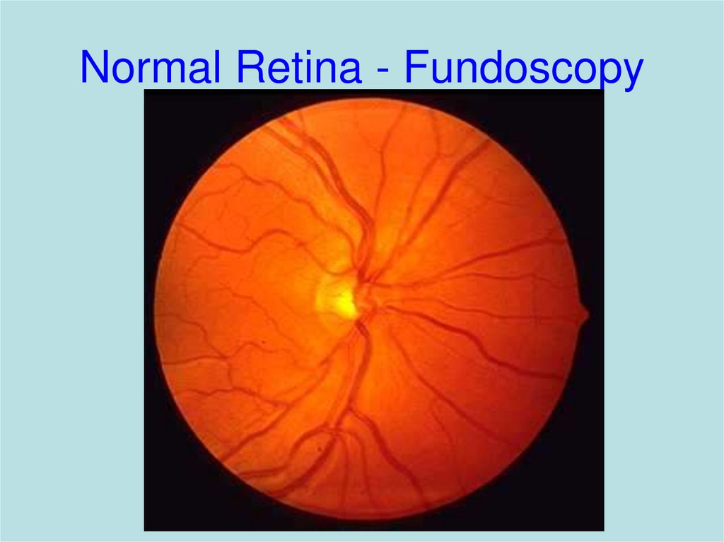 Normal Retina - Fundoscopy