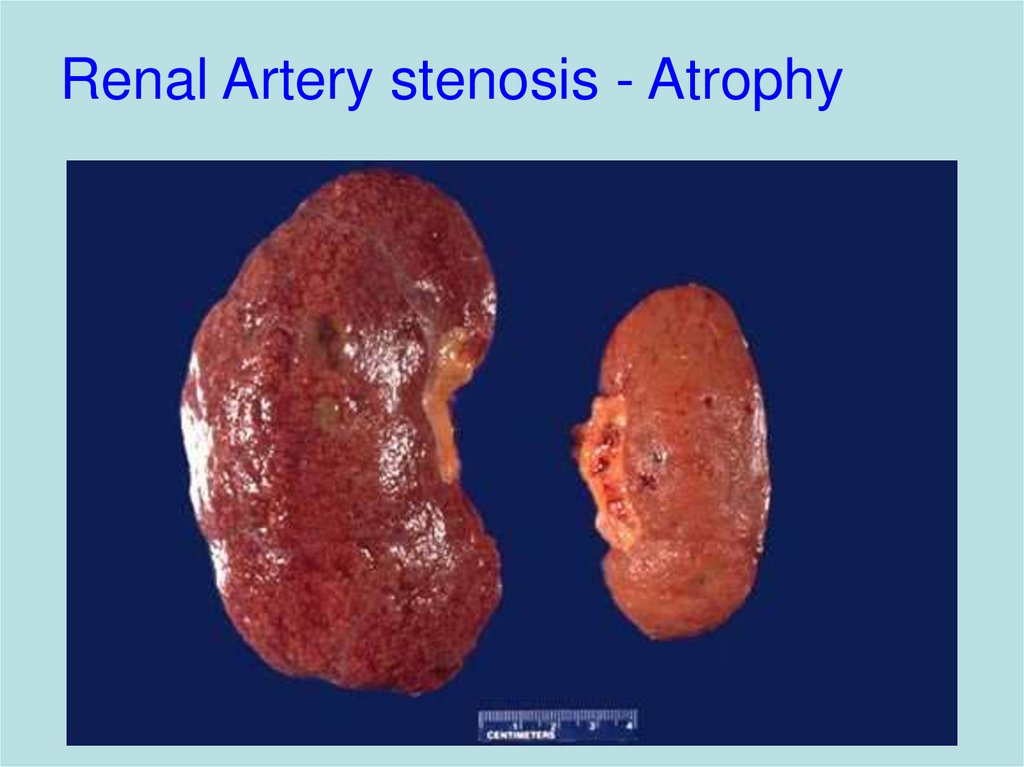 Renal Artery stenosis - Atrophy