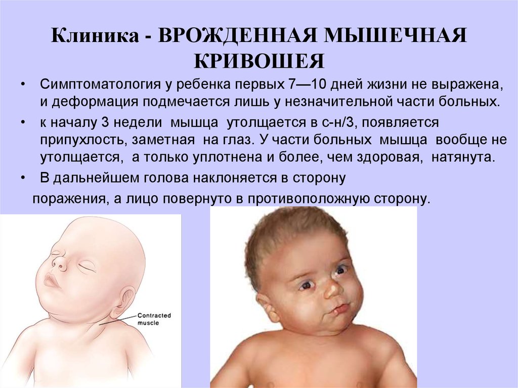 Почему у новорожденного может быть. Врожденная мышечная кривошея. Кривошея у новорожденных. Вродленная мышесная кривошея. Krivasheya.