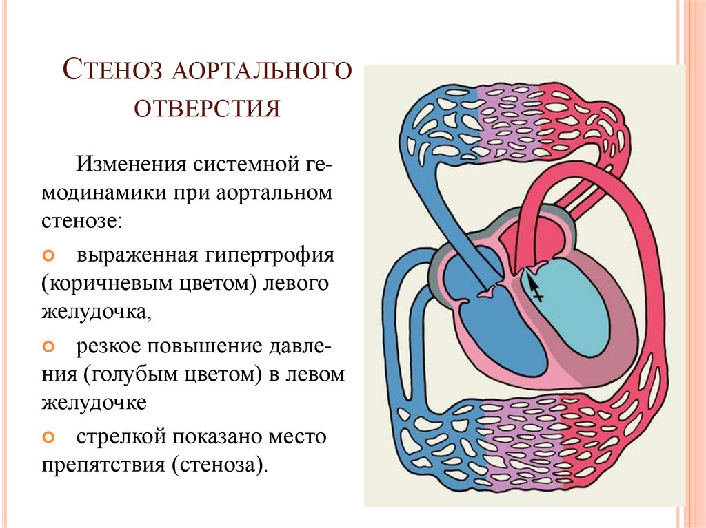 Аортальный стеноз что это такое. Стеноз аортального отверстия. Ад при аортальном стенозе. Давление при аортальном стенозе. Артериальное давление при аортальном стенозе.