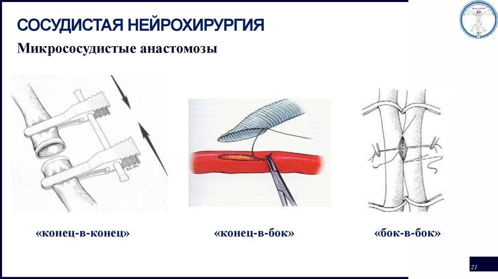 Анастомоз конец в конец схема