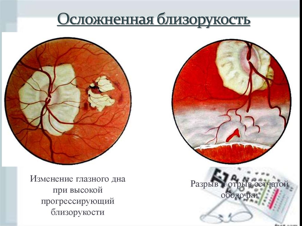 Изменение на глазном дне. Миопический конус глазное дно. Прогрессирующая близорукость осложнения.