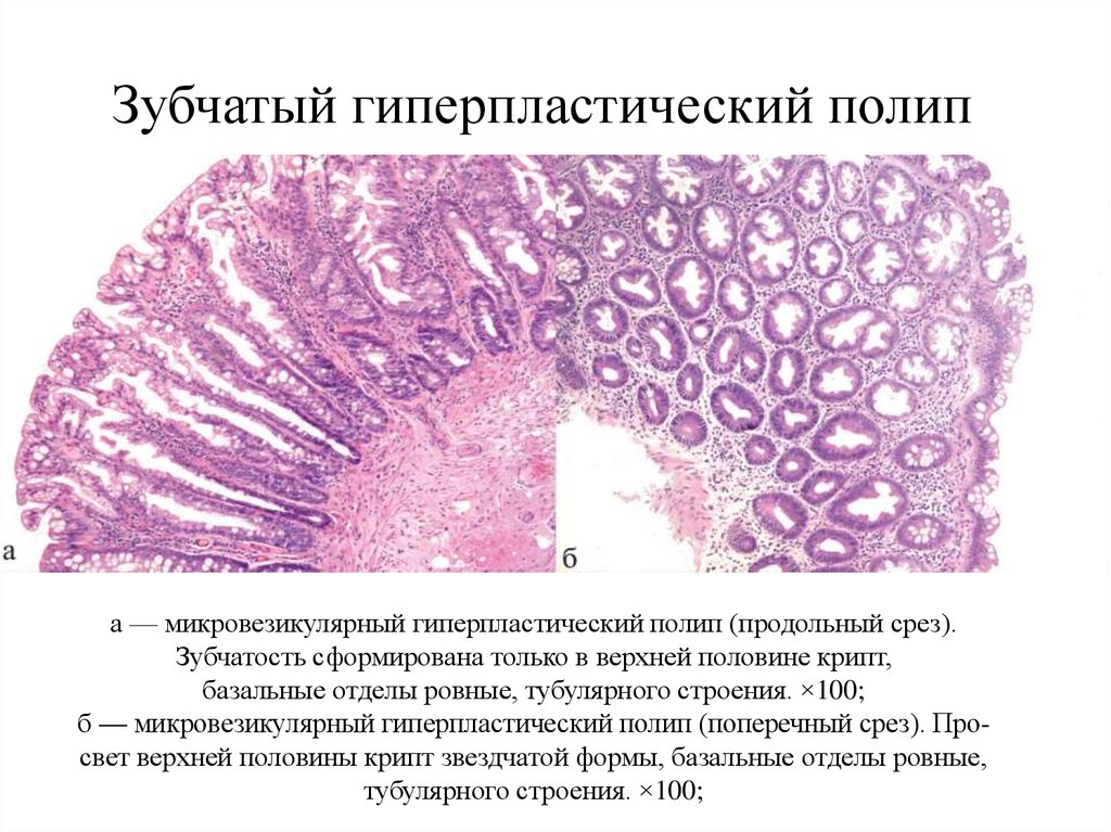 Морфологическая картина полипа