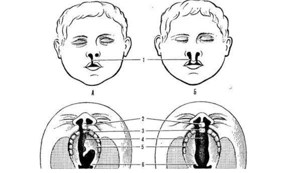 Виды расщелин при ринолалии картинки