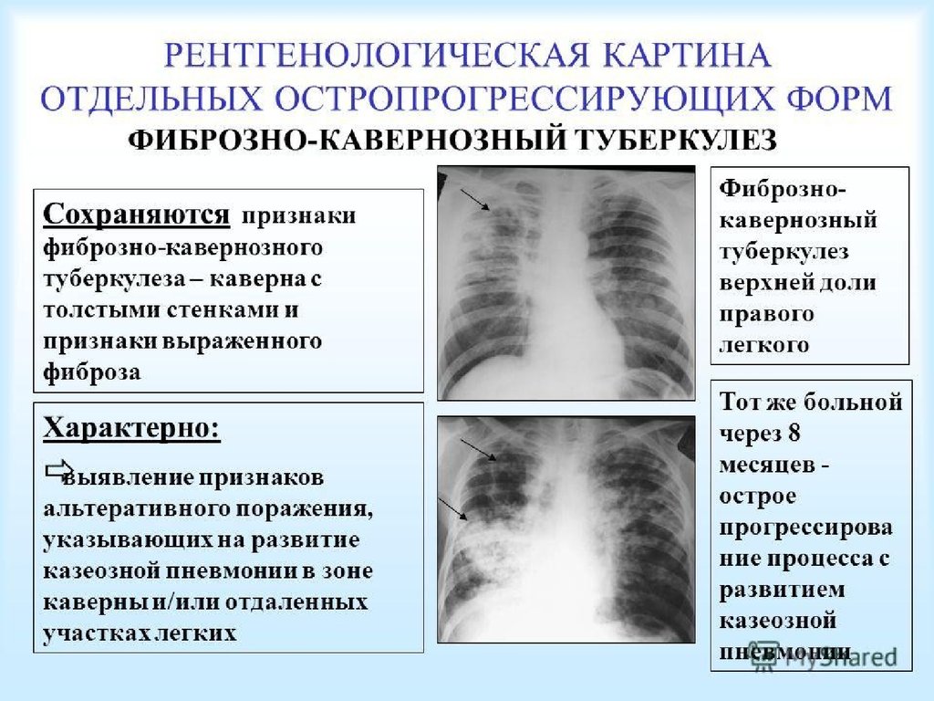 Картина фиброзных изменений. Рентген фиброзно кавернозного туберкулеза синдром. Каверна при туберкулезе на рентгене. Кавернозный туберкулез легких рентген. Фибринозно-кавернозный туберкулёз рентген.