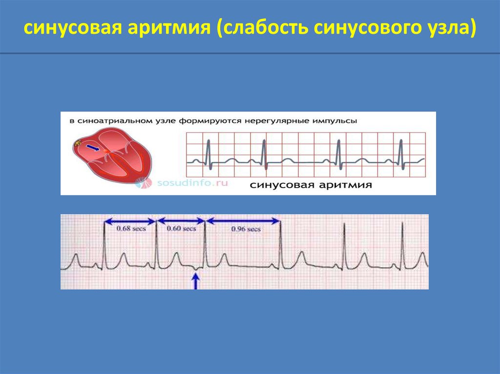 Презентация по аритмиям