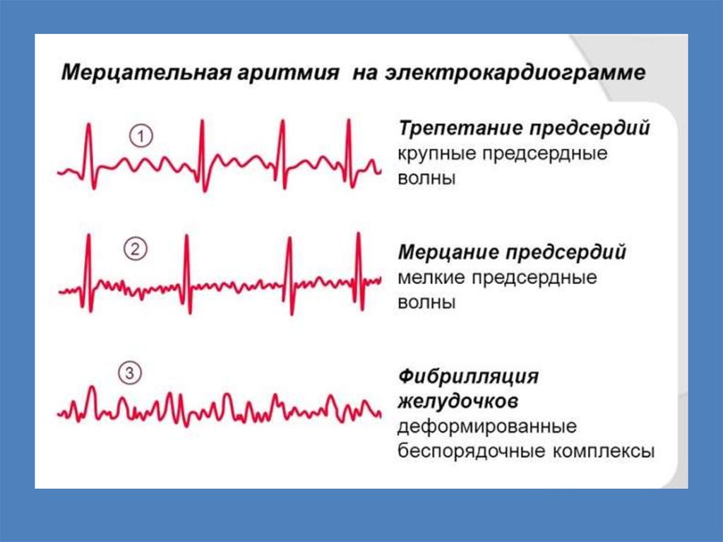 Брадикардия карта вызова