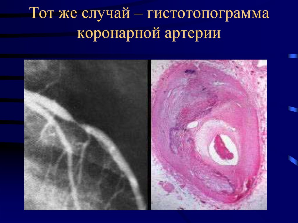 Тот же случай – гистотопограмма коронарной артерии