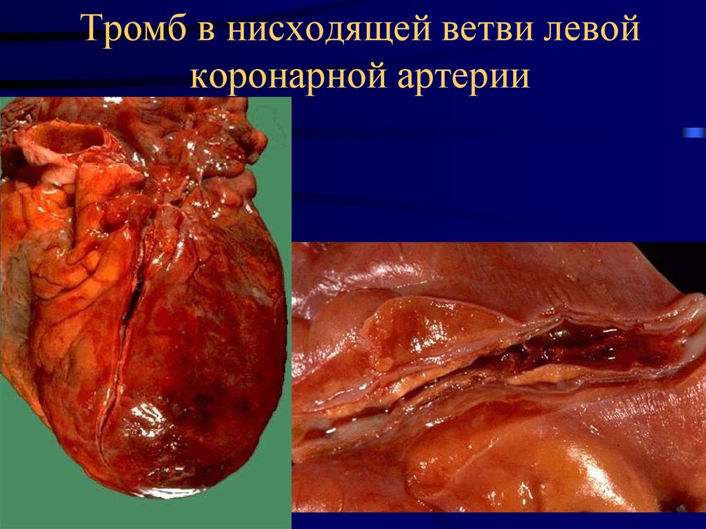 Тромб в нисходящей ветви левой коронарной артерии