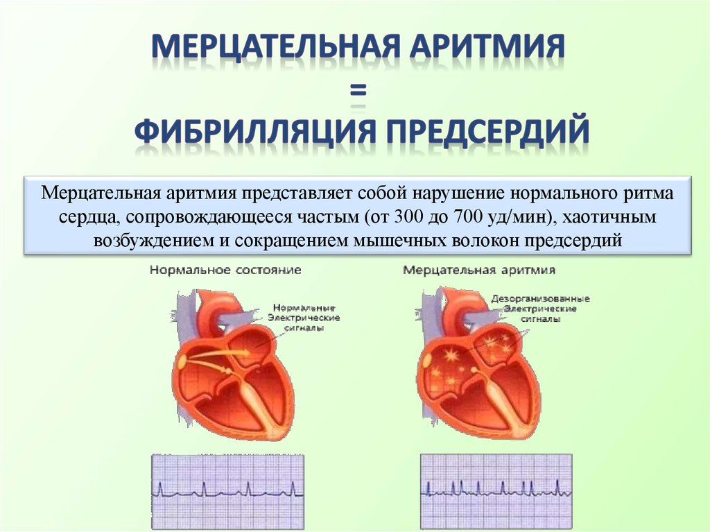 Предсердие болезни. Фибрилляция предсердий с аритмие 2 к 2. Аритмия сердца фибрилляция предсердий. Нарушения ритма сердца фибрилляция. Мерцательная аритмия и фибрилляция предсердий.
