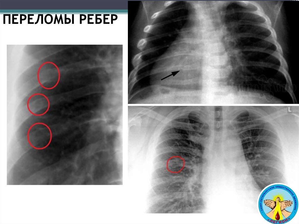 Перелом ребра. Консолидированный перелом ребра на рентгене. Консолидированные переломы ребер.