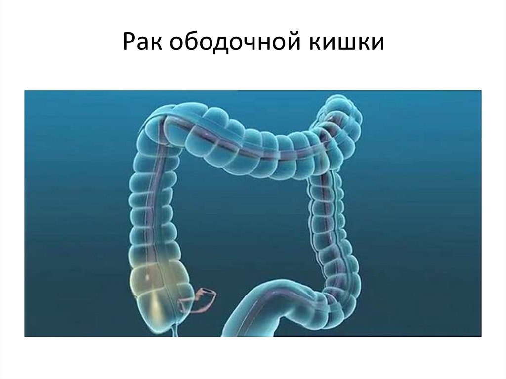 Рак ободочной