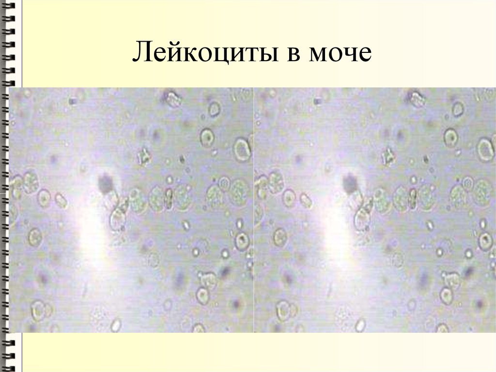 Лейкоциты в моче заболевания. Микроскопия мочи лейкоциты. Нечипоренко микроскопия. Лейкоциты в моче микроскопия осадка. Лейкоциты и эритроциты в моче микроскопия.