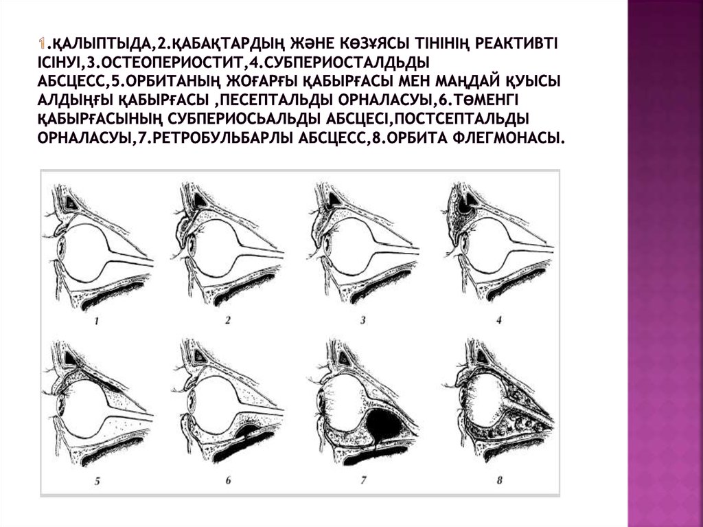1.қалыптыда,2.қабақтардың және көзұясы тінінің реактивті ісінуі,3.остеопериостит,4.субпериосталдьды абсцесс,5.орбитаның жоғарғы