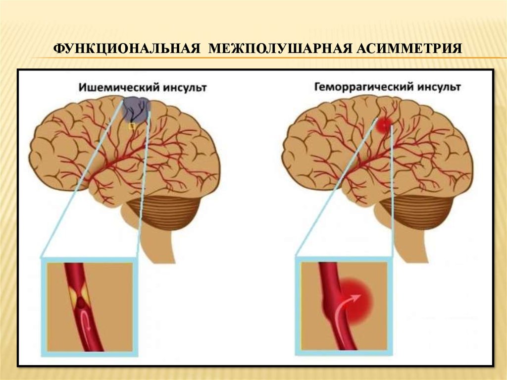 Зона инсульта. Ишемический и геморрагический инсульт. Ишемический инсульт мозга. Ишемический и геморрагический инсульт головного мозга. Типы геморрагического инсульта.