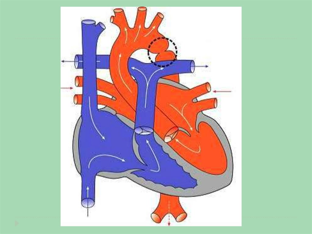 Оап у новорожденных. Открытый артериальный (боталлов) проток (ОАП). Открытый артериальный проток (ОАП). Открытый артериальный проток Баталов. ВПС открытый артериальный п.