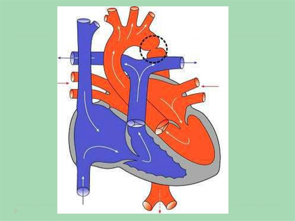 Открытый аортальный проток схема
