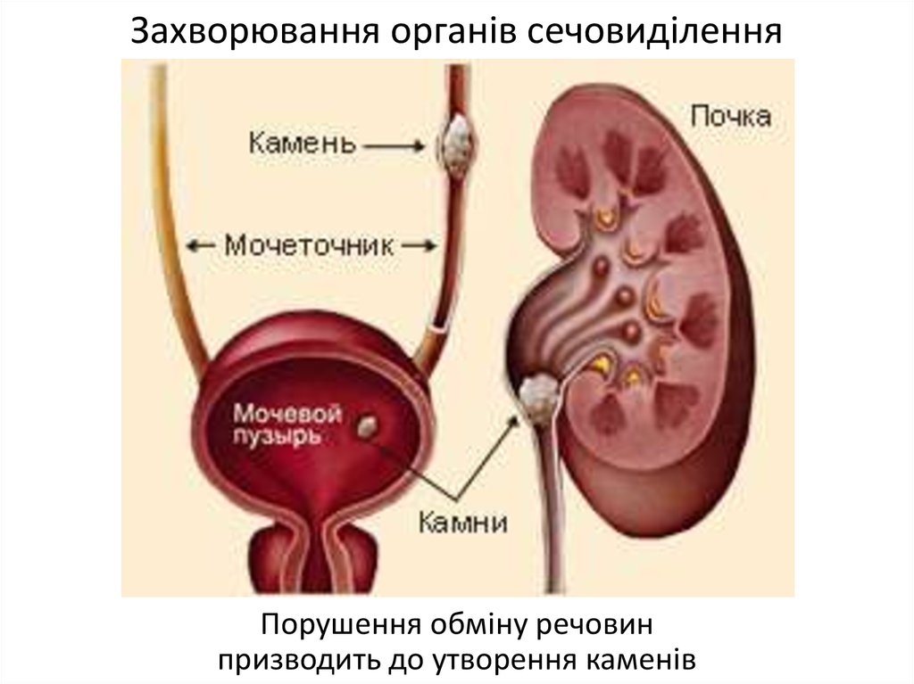 Камень в мочеточнике. Почки и мочеточники. Строение почки и мочеточника. Камень в мочеточнике у женщин.