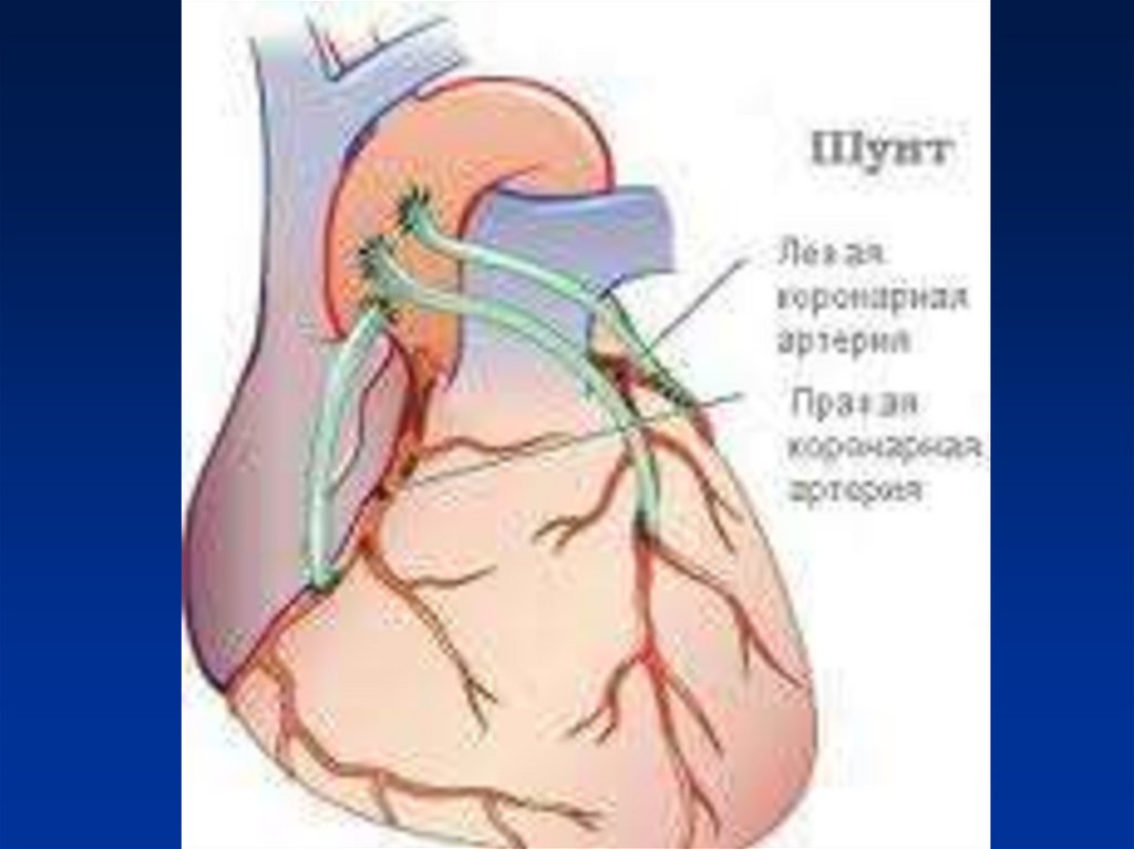 Как выглядит шунт. Операция шунтирование сосудов сердца. Аортокоронарное шунтирование (АКШ). Аорта коронарное шунтирование. Маммарно коронарное шунтирование.
