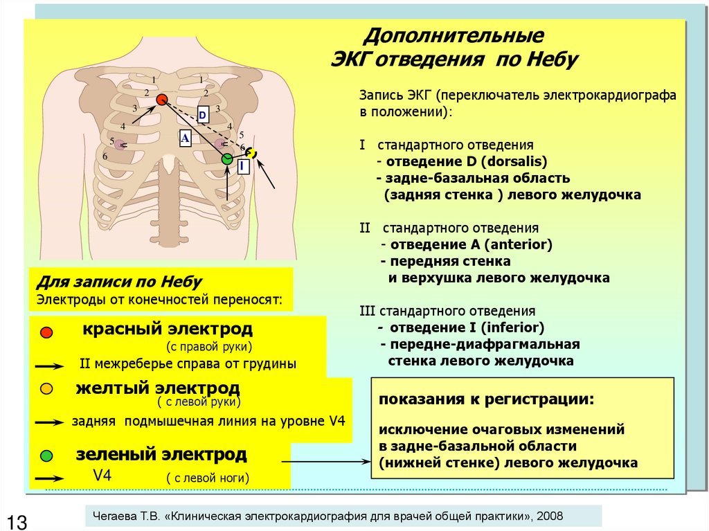 Электроды для экг схема