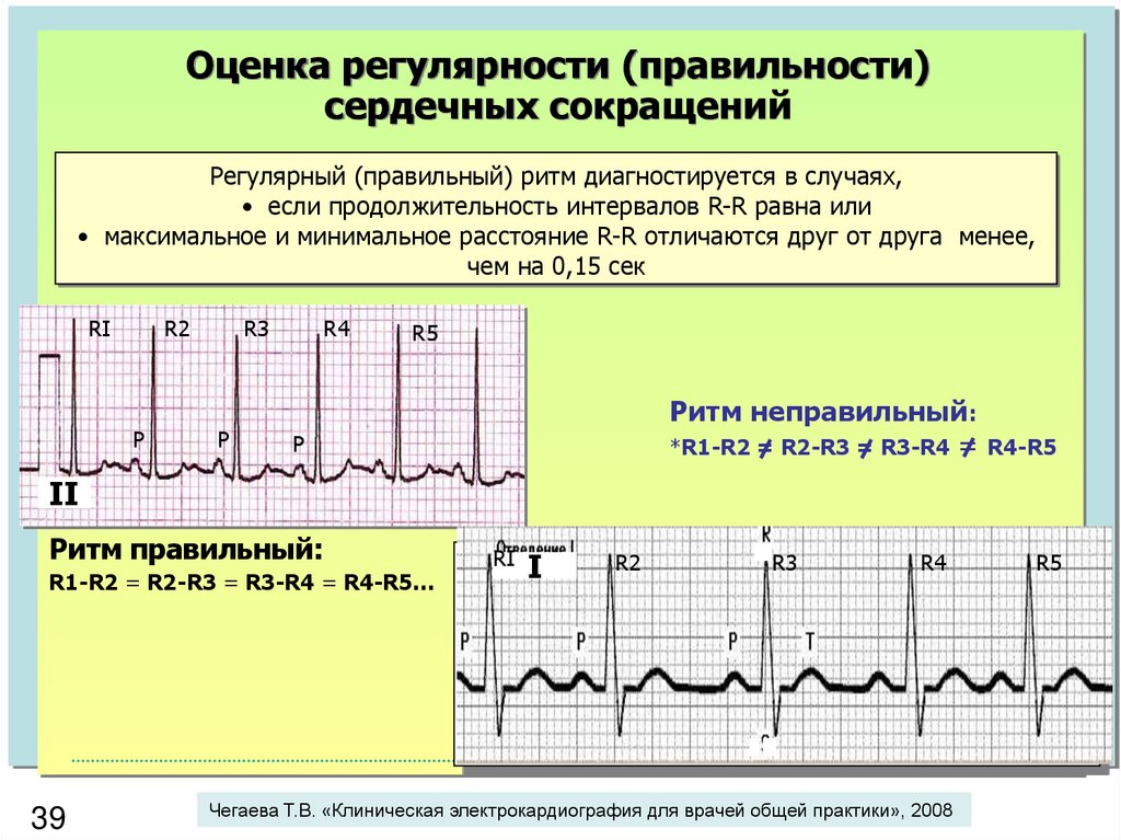 Как измерить частоту сердечных. Правильный синусовый ритм на ЭКГ. Правильный и неправильный ритм на ЭКГ. Неправильный синусовый ритм. Неправильный синусовый ритм сердца ЭКГ.