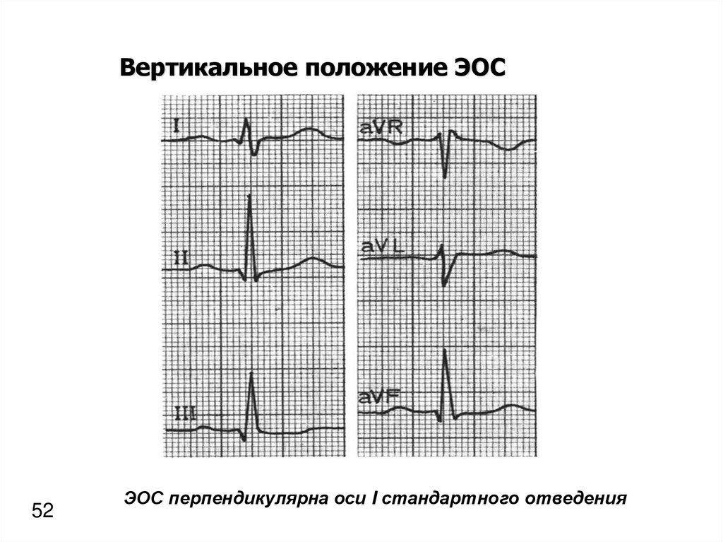 Что значит вертикальная ось. ЭКГ при вертикальном положении ЭОС. Вертикальное положение ЭОС на ЭКГ. Вертикальная ЭОС сердца на ЭКГ что это. ЭКГ электрическая ось вертикальная.