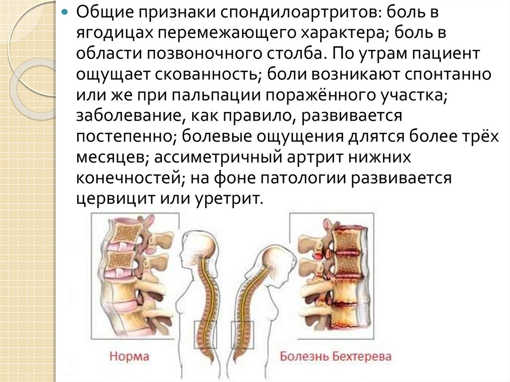 Анкилозирующий спондилез