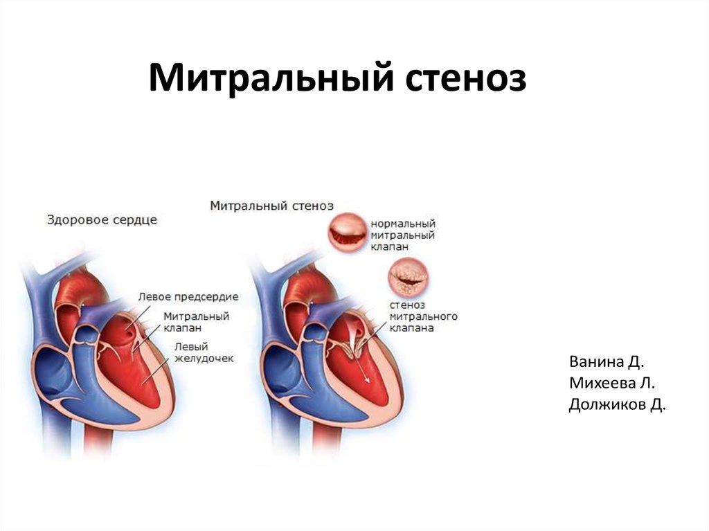 Митральный аортальный стеноз. Стеноз митрального клапана сердца. Стеноз и недостаточность митрального клапана. Ревматизм митральный стеноз. Сужение митрального клапана.