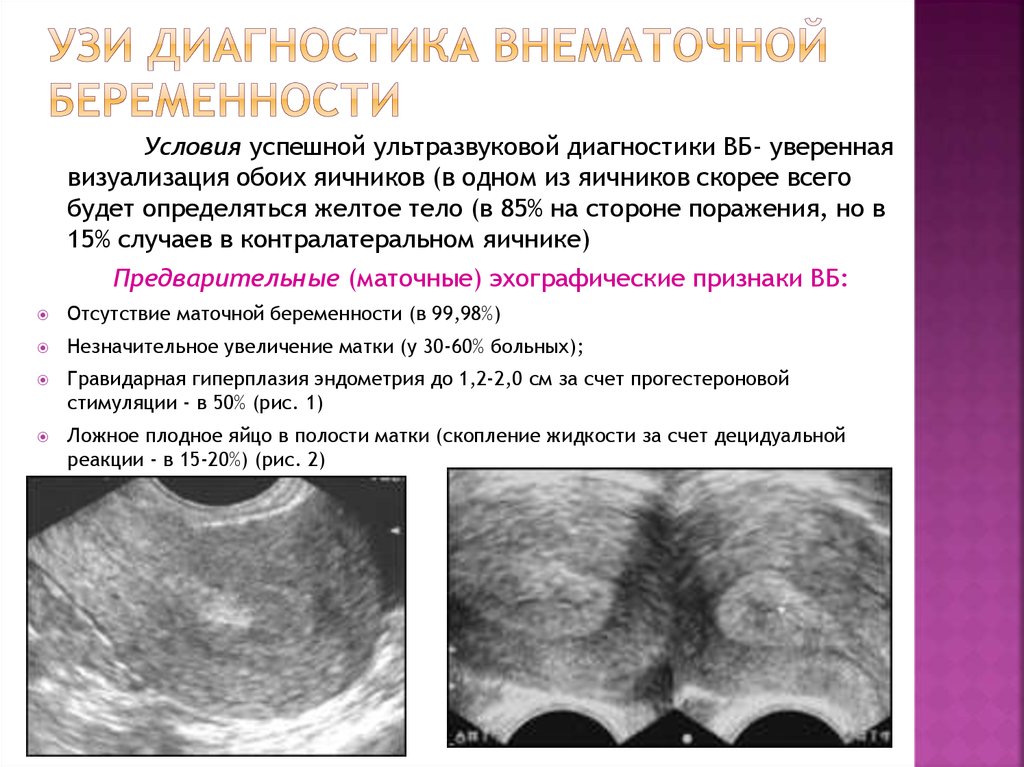 Внематочная эндометрий. УЗИ при разрыве маточной трубы. Внематочная беременность на УЗИ. УЗИ при внематочной беременности. Трубная беременность УЗИ.
