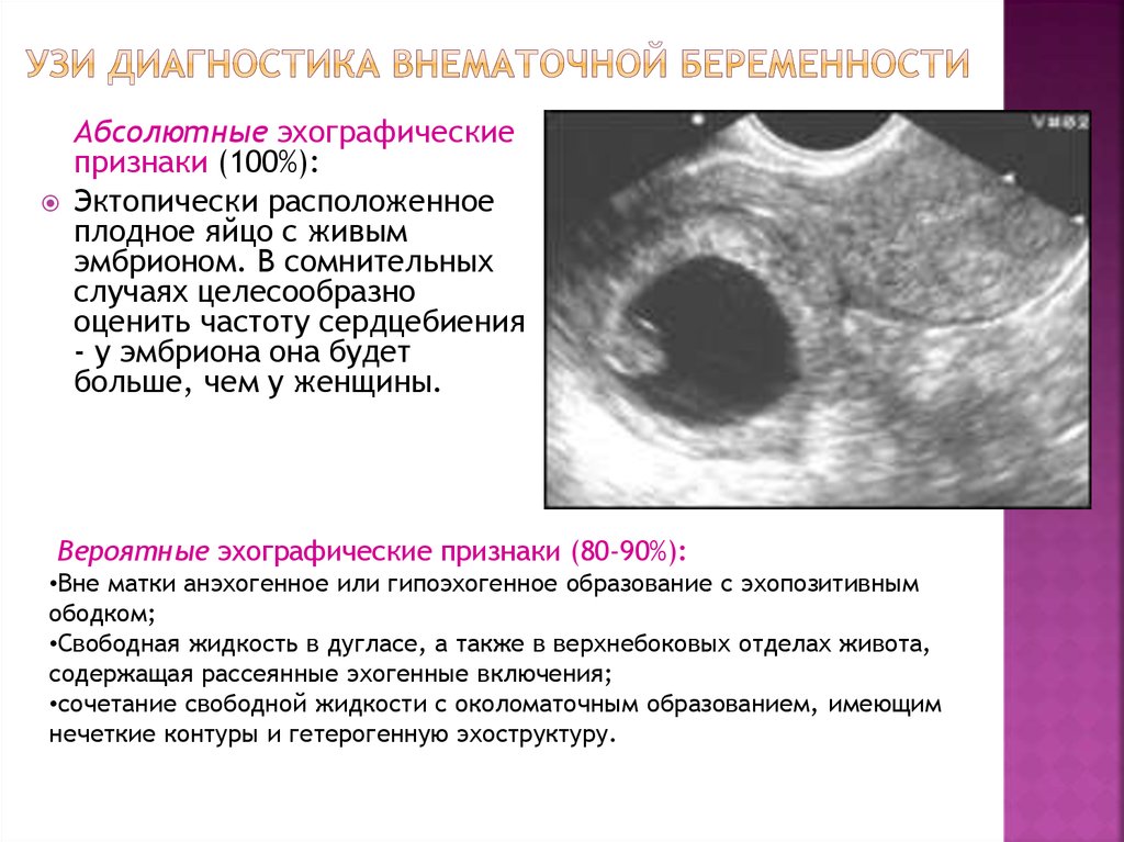 Забеременела без труб естественным путем. Внематочная беременность 6 недель УЗИ. Внематочная беременность эхограммы. УЗИ при внематочной беременности на ранних сроках. Замершая внематочная беременность на УЗИ.