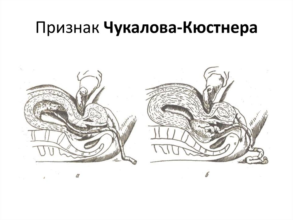 Признаки отделения плаценты