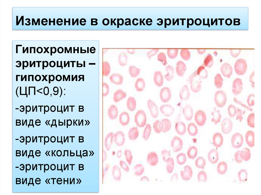 Гипохромия железодефицитная анемия. Гипохромия анизоцитоз микроцитоз. Гипохромия и гиперхромия. Гипохромия эритроцитов средней степени. Гипохромные эритроциты в крови.