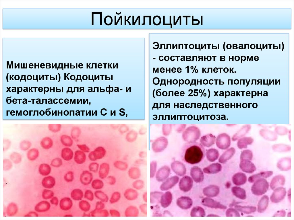 Эллиптоцитоз. Эллиптоциты (овалоциты). Форму патологии клеток системы крови. Пойкилоцитоз овалоциты. Укажите форму патологии клеток системы крови.